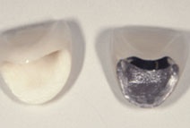 オールセラミックとメタルボンド オールセラミックとメタルボンド