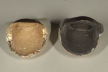 セラミック+純金とレジン樹脂前装冠 セラミック+純金とレジン樹脂前装冠