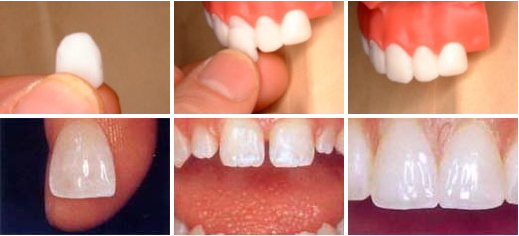 ラミネートベニア ラミネートベニア