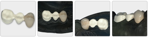 金属を使わないブリッジ 金属を使わないブリッジ