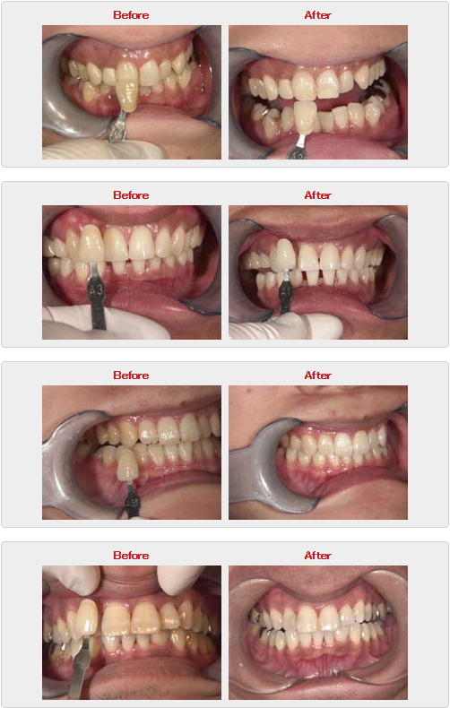 ホワイトニング症例